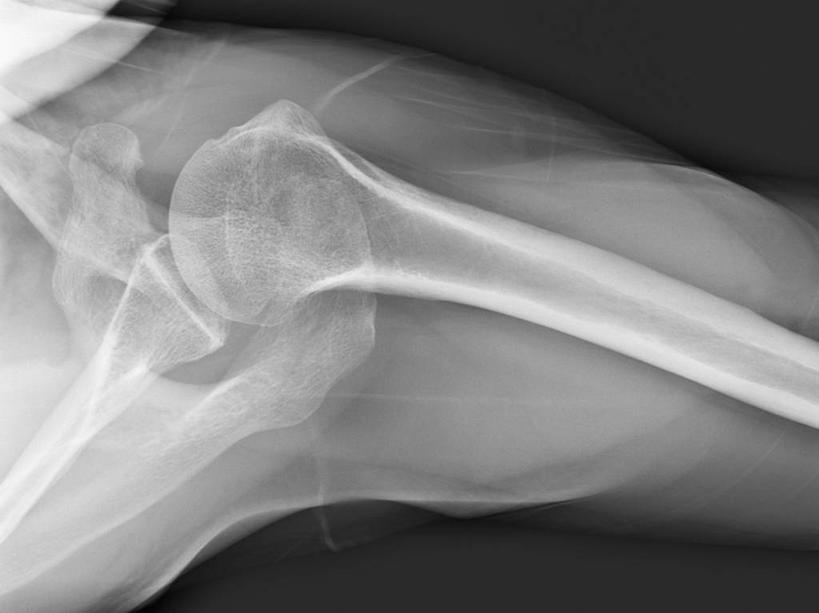 肩,肩胛骨,关节,一个人,横图,黑白,x光片,特写,辐射,科学,医学,骨头,摄影,部分,医疗,科学技术,x射线,x光,肱骨,人体结构,电磁波,电磁辐射